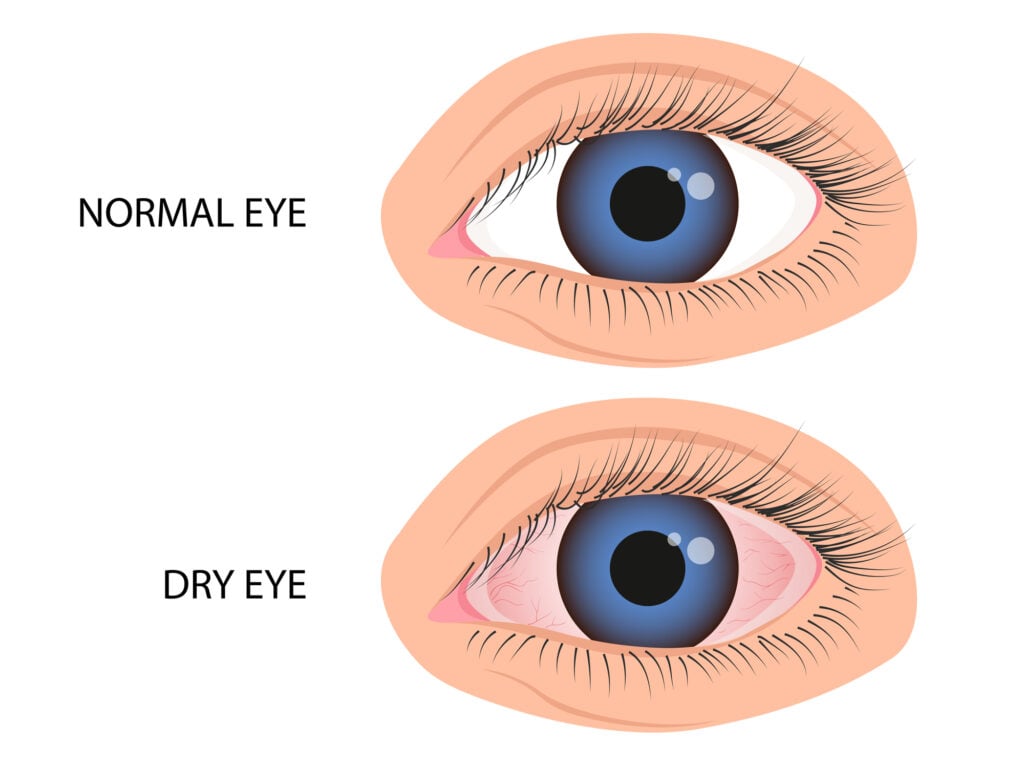 A comparative illustration of a normal eye vs a dry eye