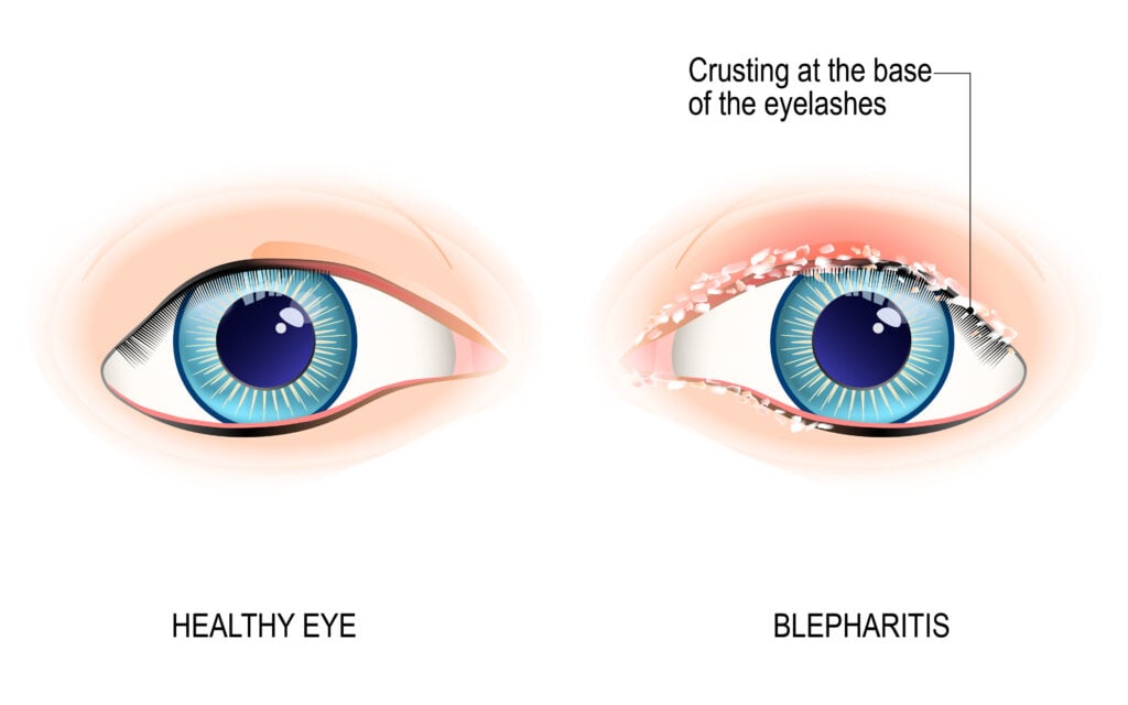 Eyes of human. Blepharitis is a inflammation of the eyelid. Crusting at the eyelid margins (base of the eyelashes) due to excessive bacterial buildup along the lid margins. Human anatomy. Vector diagram for educational, and medical use.