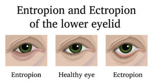 What is Entropion Surgery?