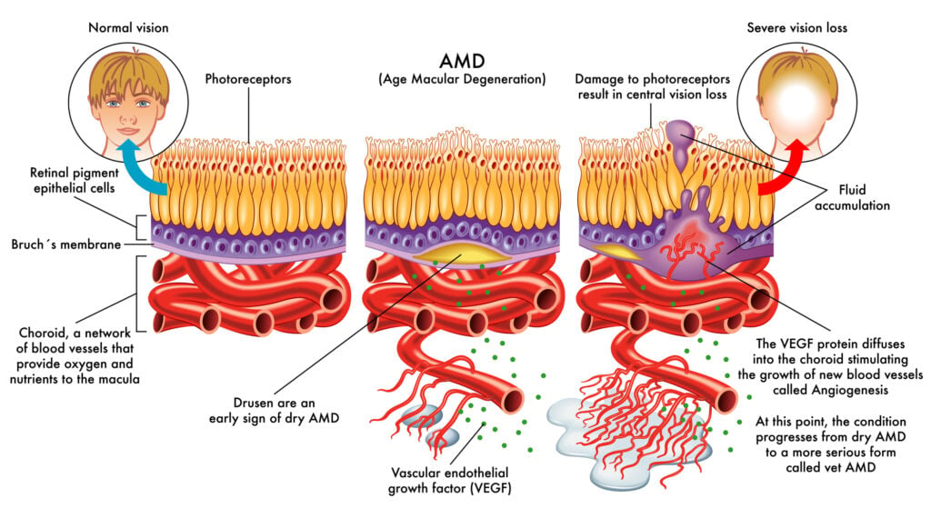 AMD Macular degeneration flow chart