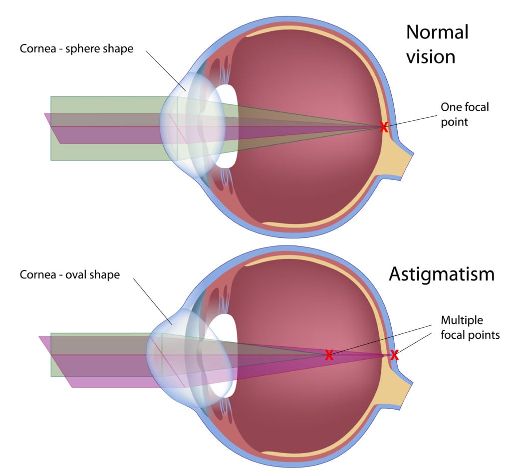 diagram showing eye with normal vision vs astigmatism