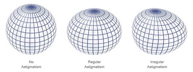 astigmatism sphere