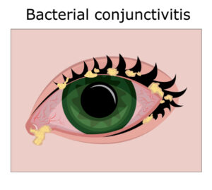 Bacterial conjunctivitis