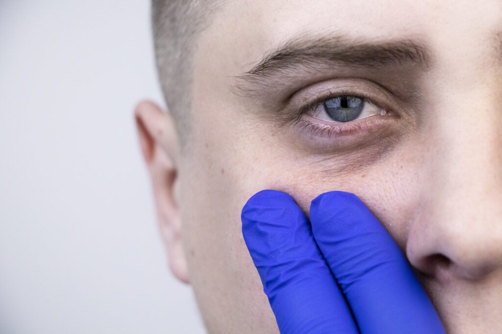 Bags under the eyes as shown by a stressed man with two fingers pointing at the area