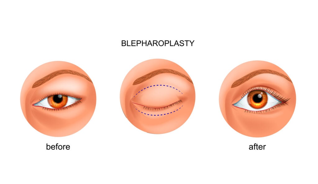 Blepharoplasty before and after illustration