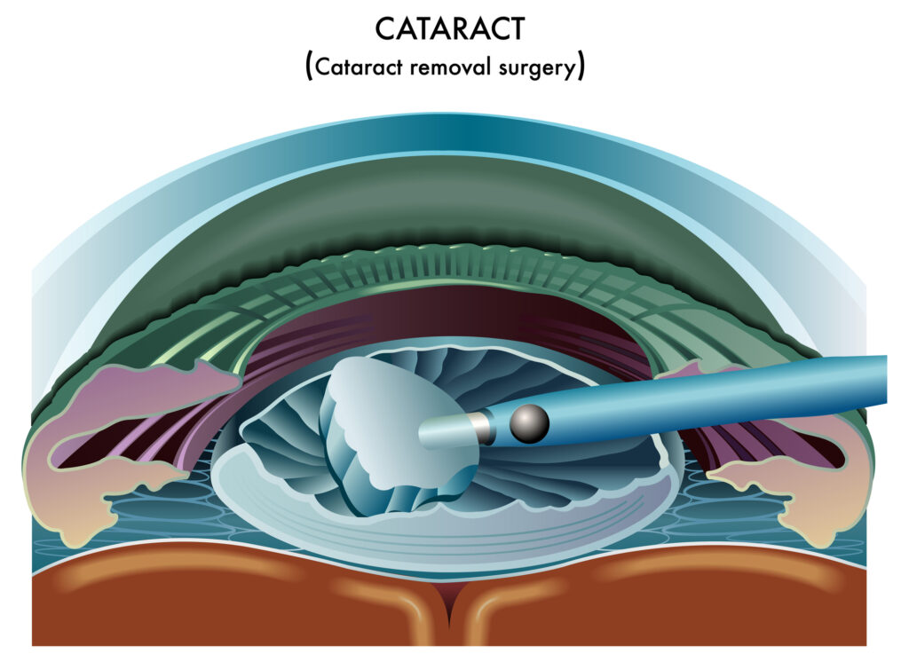 Cataract Surgery