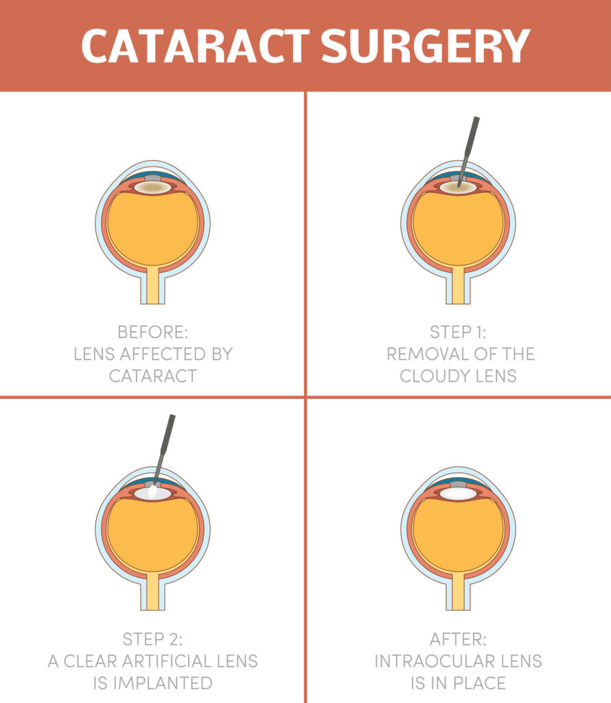 Cataract surgery procedure infographic