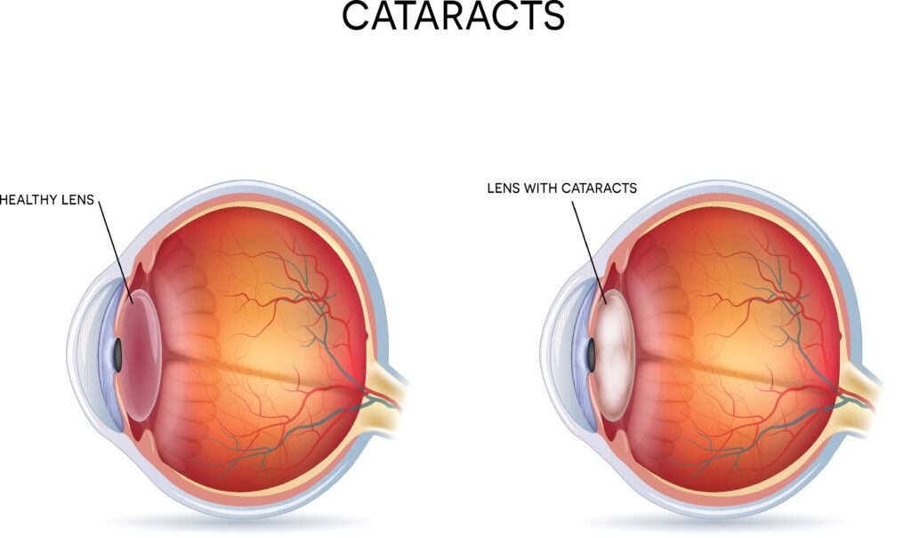 cataracts