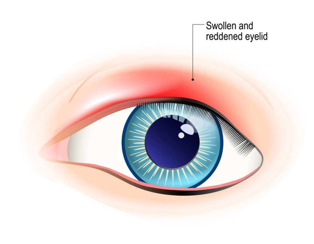 chalazion