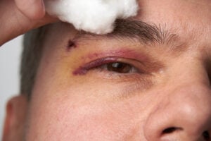 How to Get Rid of a Black Eye Fast