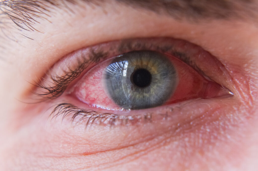 Conjunctivitis or pink eye close up on eye