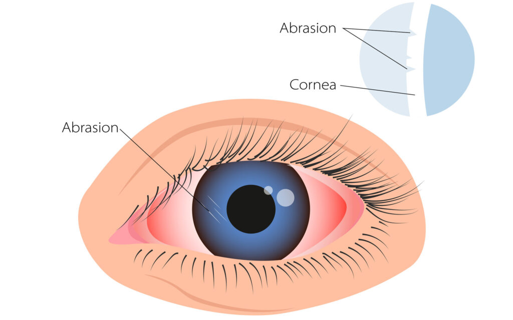 Corneal Abrasion illustration edited