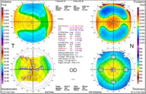 corneal topography