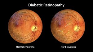 What Is a Diabetic Eye Exam?