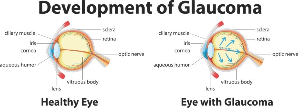 graphic showing the development of glaucoma