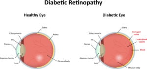 How Does Diabetes Affect the Eyes?