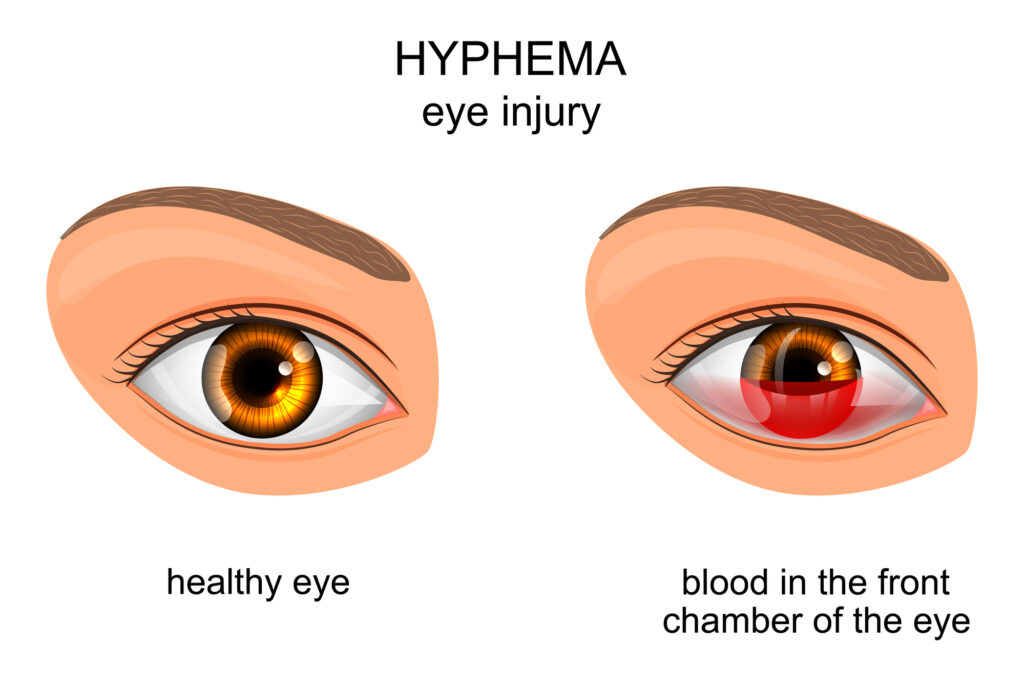 Eye Injury