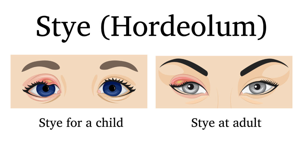 Illustration of Stye