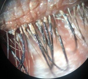 What Are Eyelash Mites?