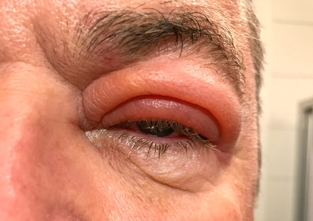 Eyelid Swelling