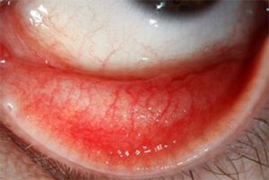 What Is Follicular Conjunctivitis?