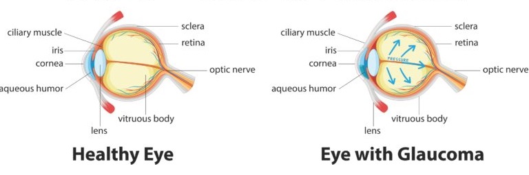 How glaucoma develops - Healthy Eye vs Eye with Glaucoma