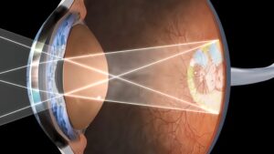 The Significance of the LASIK Flap in Laser Eye Surgery