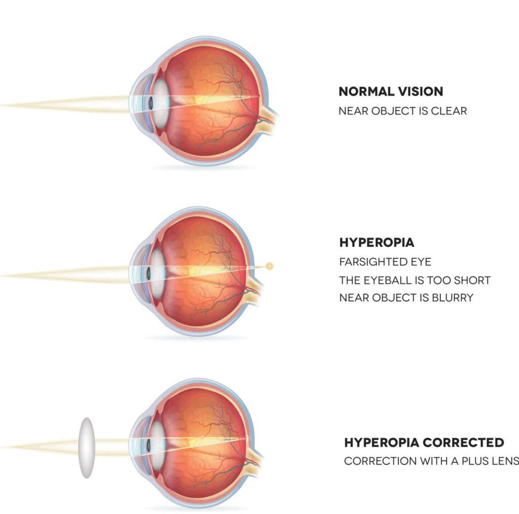 diagram comparing normal vision, hyperopia, and hyperopia corrected