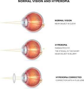 Farsightedness: What It Is, How It's Treated