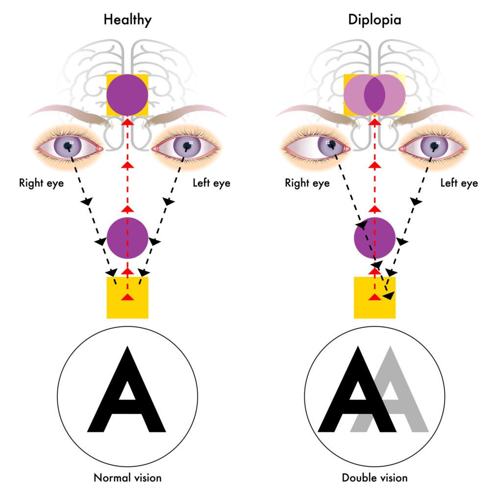 Illustration depicting Diplopia or double vision and Healthy Eye vision comparison