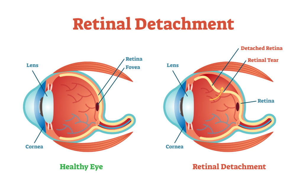 Illustration of a healthy eye vs an eye suffering Retinoschisis or retinal detachment or the separation of retina