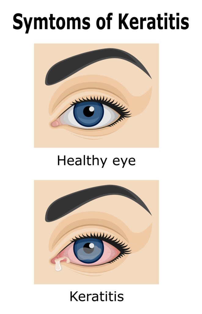 Illustration of Keratitis