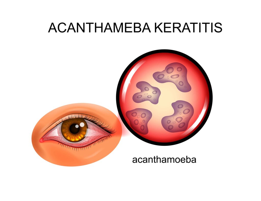 Illustration of Parasitic keratitis or Acanthamoeba keratitis