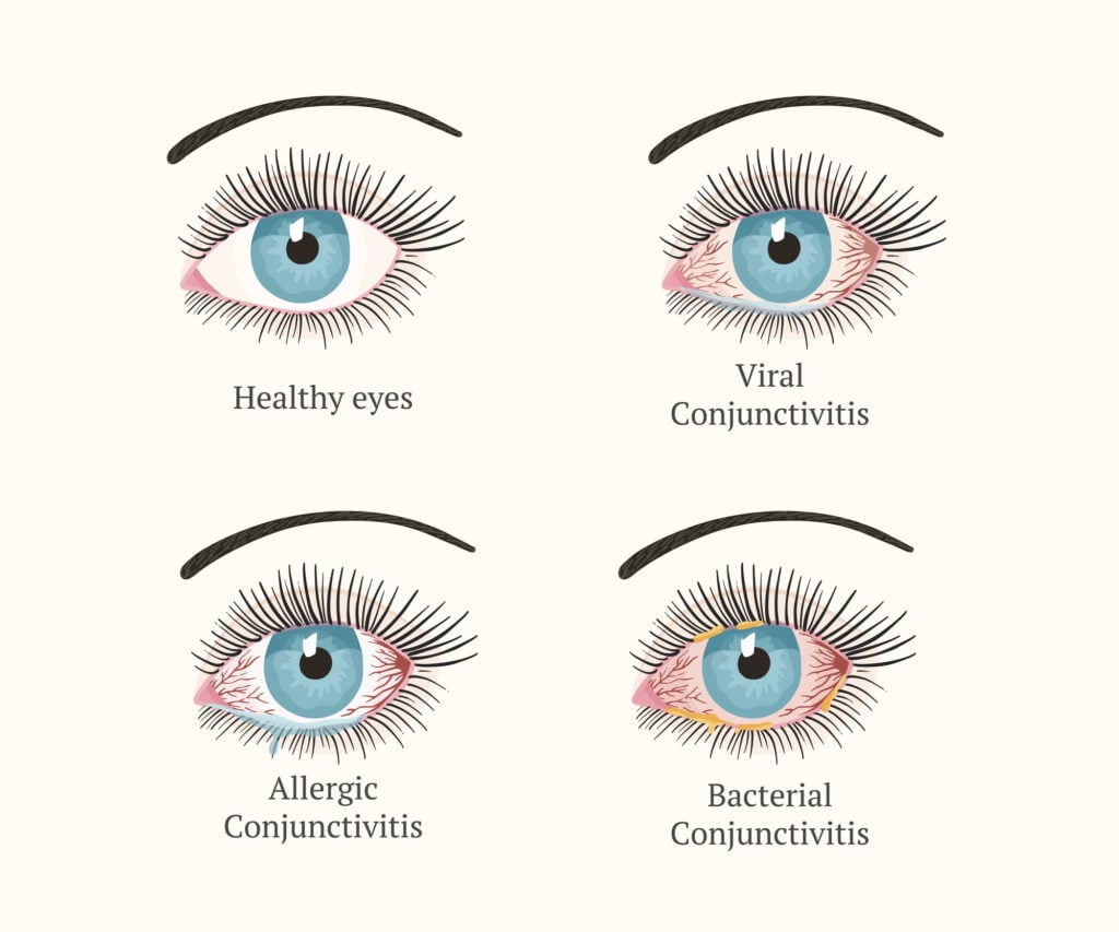 Illustration of types of Conjunctivitis in the eyes