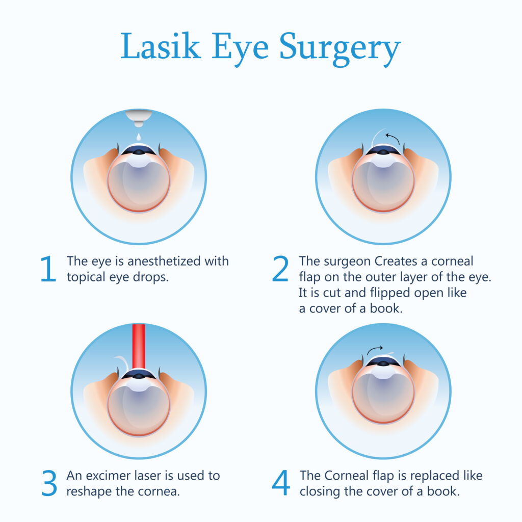 Laser eye surgery