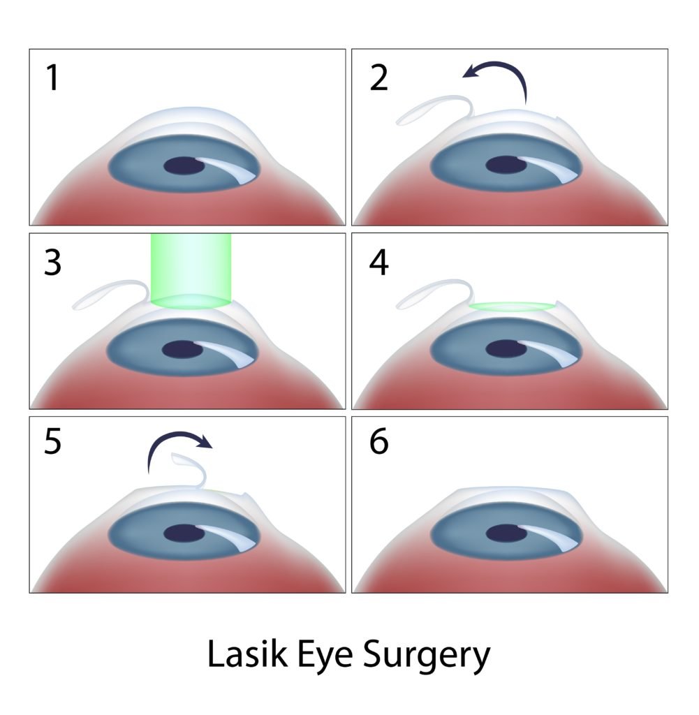 diagram showing six steps of lasik eye surgery