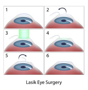 lasik eye surgery steps