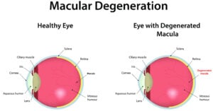 What is Age-Related Macular Degeneration? Causes, Prevention, & Treatment