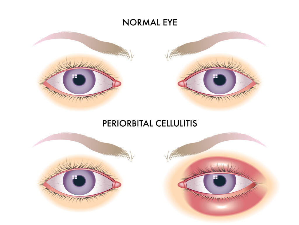 Medical illustration showing periorbital cellulitis vs a healthy normal eye