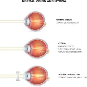 Myopia (Nearsightedness)