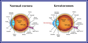 Corneal Dystrophy