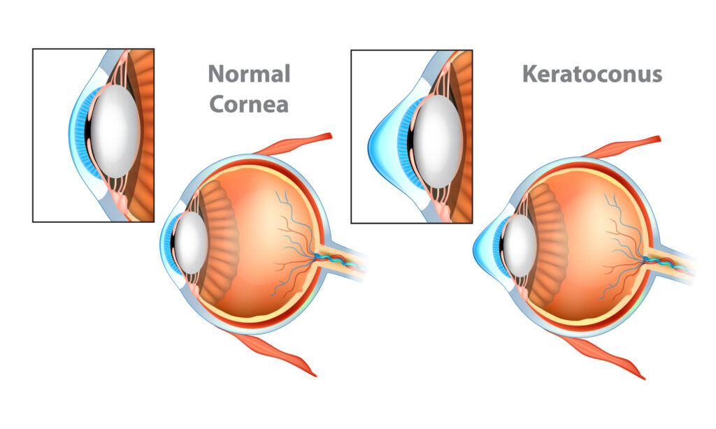 normal cornea vs Keratoconus eye