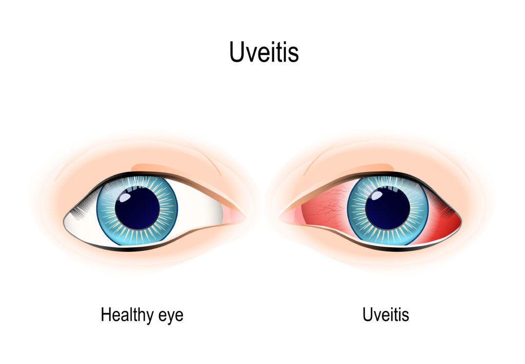 Normal eye vs Uveitis illustration