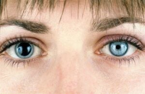 Anisocoria (Unequal Pupil Sizes): Causes & Treatments