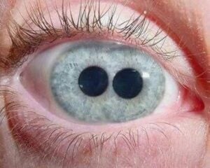 Polycoria (Two Pupils in One Eye)