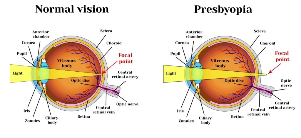 graphic showing normal eye and presbyopia