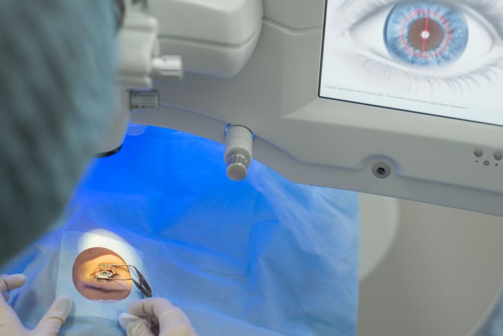 PRK surgery photo of a patient in operating room