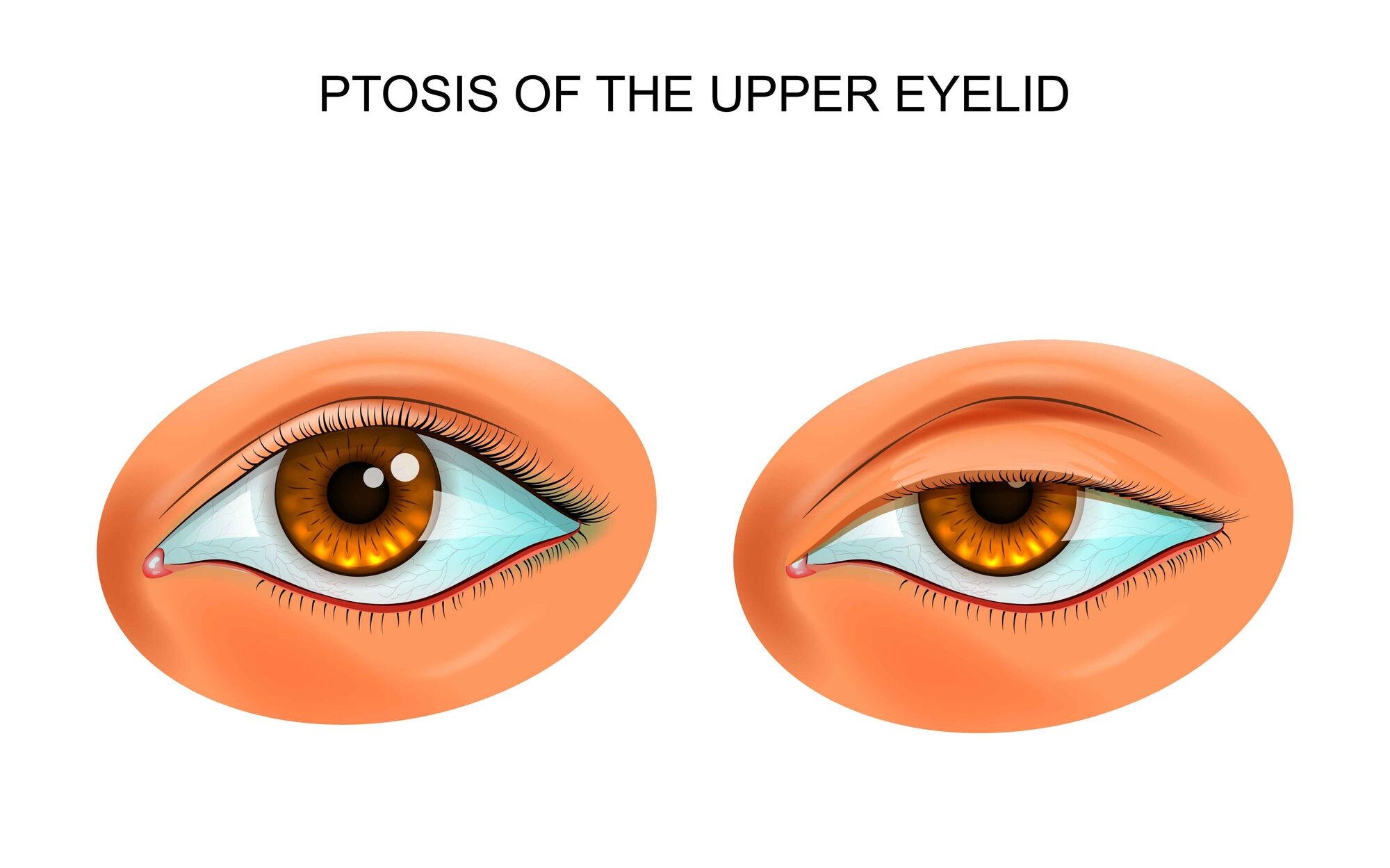 Ptosis or Droopy Eyelid Illustration edited