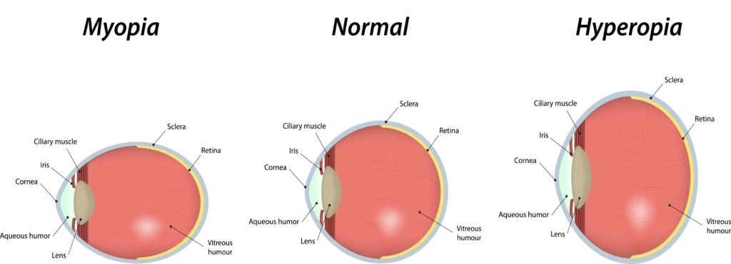 graphic comparing normal vision, myopia refractive error, and hyperopia refractive error