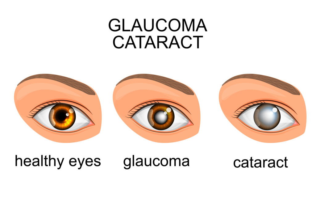 Refractive errors illutration